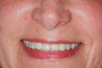 Patient at presentation. Notice the unattractive left to right cant of the four maxillary incisors.