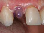 The prepared tooth is totally-etched prior to the application of Brush&Bond Universal adhesive resin.
