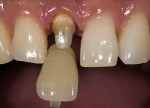 Figure 15  Image of hydrated tooth with shade tab.