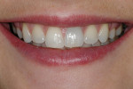 Photograph of patient before single tooth whitening treatment.