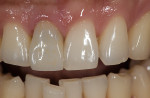 Figure 19  Comparing the preoperative and postoperative photographs helps demonstrate the dramatic results of this shade-matching technique.