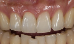 Figure 20  Comparing the preoperative and postoperative photographs helps demonstrate the dramatic results of this shade-matching technique.