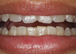 Fig 1. Female patient presented with chief complaint of incisal edge chipping and inadequate incisal display.