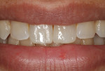 Fig 9. Completion of restoration of both central incisors.