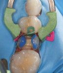 Fig 14. After removal of existing restoration
and tooth preparation, a selective-etch protocol was used.