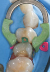 Fig 16. Occlusal restoration with shades A1 and Incisal for 3-dimensional esthetics.
