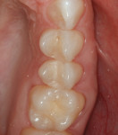 Fig 13. Female patient presented with recent pain upon chewing on upper right second bicuspid.