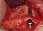 Fig 3. Large buccal dehiscence type defect apparent after implant placement.