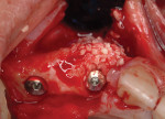 Fig 4. Mineralized bone allograft used to obturate defect.