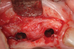 Fig 9. After removal of membrane, resolution of peri-implant defect was evident.