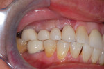 Fig 10. Restoration of site with screw-retained, three-unit FPD (restorative treatment performed by Gregg Rothstein, DMD).