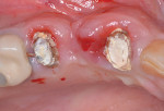 Fig 11. Case 2, initial presentation showing symptomatic abutment teeth.