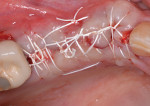 Fig 13. Flaps sutured.