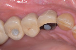 Fig 15. Site restored with screw-retained, three-unit, implant-supported FPD.