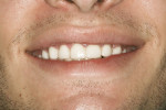 Figure 8  Smile view with provisional restoration in place.
