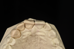Fig 3. Incisal view shows the final torsion and rotation in natural tooth form.