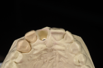 Fig 5. Removable alveolar cast with tooth removed. The incisal position view shows the form dictated by the emergence profile of the individual tooth. Each tooth emergence profile is different and should follow the individual form of its root emergence.