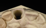 Fig 8. A close-up of natural teeth shows the cervical enamel junction (CEJ). The finish line/margin of most prepared teeth are prepared close to the CEJ. The technician’s role is to replicate nature and to support the free gingival tissue. The use of a tissue cast helps the technician to see the emergence profile and manage the gingival support and esthetics.