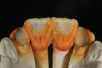Fig 19. Palatal view and finalizing with high-value enamel.