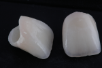 Fig 22. Morphology, surface texture, self-glaze, and mechanical polish of the final restorations with the One-Bake Technique.