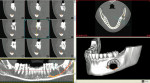 Figure 15b  Preoperative CT scan viewedin Simplant software revealing thedimensions of the tumor.
