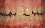 Preoperative tetracycline-stained teeth to be bleached nightly with 10% carbamide peroxide
in a non-scalloped, no-reservoir tray.