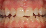 Overnight bleaching of one arch for 3 months to 4 months with 10% carbamide peroxide shows improvement, but not as significant as normal teeth would demonstrate.