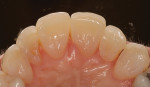 Nightly bleaching with 10% carbamide
peroxide for 4 months lightens the teeth, which can change the apparent shade of the veneers if they are not too opaque.