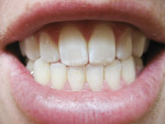 Figure 1  18-year-old patient with post-orthodontic white-spot lesions.
