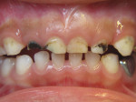 Anterior Decay Treated with Silver Diamine Fluoride. Image courtesy of Travis M. Nelson, DDS, MSD, MPH.