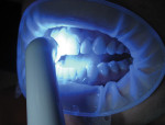 Figure 7  The treated teeth were light-cured.