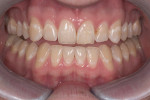 Figure 1  Compared to the preoperative photograph, the incisal translucency of the newly restored teeth harmonizes with the balance of the smile. The unique incisal edge contours enhance the natural appearance as the direct composites blend into the