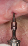Fig 1. The LOCATOR F-Tx abutment driver was used to seat the abutments onto the implants.
