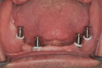 Fig 5. Impression copings were aligned to each other as much as possible prior to the definitive impression of the edentulous jaw.