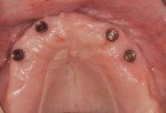 Fig 2. The abutments torqued onto the implants of the maxillary arch.