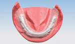 Fig 7. CAD virtual design of the proposed mandibular framework for the prosthesis.
