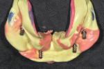 Fig 6. Occlusal view of the analogues snapped into the impression copings of the mandibular definitive impression.
