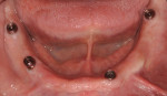 Fig 3. The abutments torqued onto the implants of the mandibular arch.