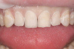 Figure 3  The initial preparation of the four incisors was accomplished to a minimal depth of 0.3 to 0.5 mm, but extended in areas where necessary to eliminate the deeper blemishes and previous restorations.
