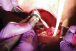 Fig 4. Implants were placed into the prepared osteotomies, ensuring primary stability of the implants.