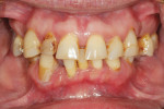 Fig 1. A patient presented with a failing dentition and requested a fixed dental implant prosthesis using minimally invasive surgical procedures.