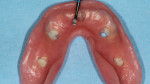 Fig 7. CHAIRSIDE Light Body PVS material was placed into the intaglio of the denture and seated onto the edentulous ridge. Any areas of show-through were adjusted, preparing recesses within the intaglio of the prosthesis. The housings were picked up in the prosthesis using CHAIRSIDE Attachment Processing Material.