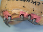 Fig 6. After insertion of the housings on the LOCATOR F-Tx abutments and making them parallel, they were welded in the dental lab with a titanium wire for cross-arch stabilization and reinforcement of the temporary bridge.