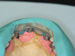 Fig 5. After the ideal teeth positioning had been determined, acrylic veneers were connected to a metal frame.