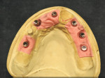 Fig 3. Cast after implant-level impression, with LOCATOR F-Tx abutments inserted.