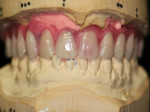 Fig 4. The design of the teeth for the long-term temporary bridge, developed in the laboratory.