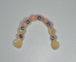 Fig 9. The processing balls were then replaced with the blue retention balls to provide fixed stability for the bridge, but allow for easy clinician removal for adjustments.