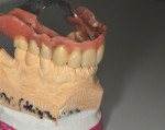 Fig 1. The patient presented with a partial denture retained by two telescopic crowns, with those two teeth failing and the denture becoming mobile. She wanted a fixed implant-retained bridge, but first it had to be determined whether such a solution was possible based on her anatomical situation and desired esthetic outcome.