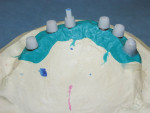 Fig 2. Waxing caps over denture attachment housing.
