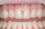 Figure 6  All teeth that were to be restored were built up prior to the development of the final labial contours and finishing and polishing.